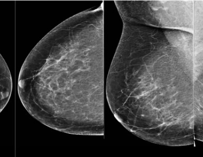 Google AI System Could Used to Detect Breast Cancer Detection